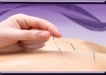 acupuncture needles going into skin