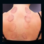 round bruises are cupping marks on woman's back